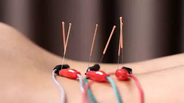 Electroacupuncture in Denver