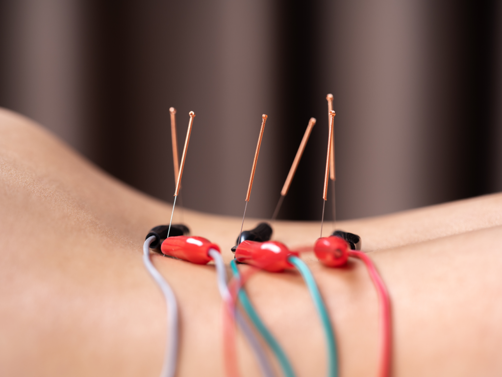 Acupuncture vs Dry Needling
