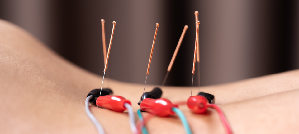 Acupuncture vs Dry Needling