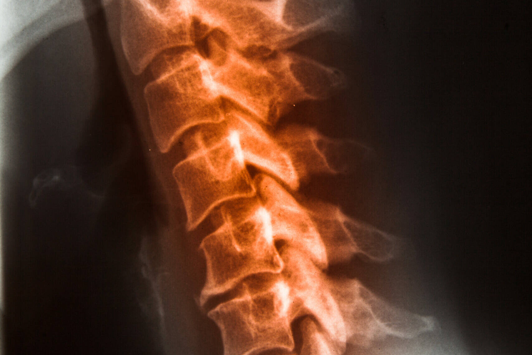 chiropractic x-rays in Denver, CO