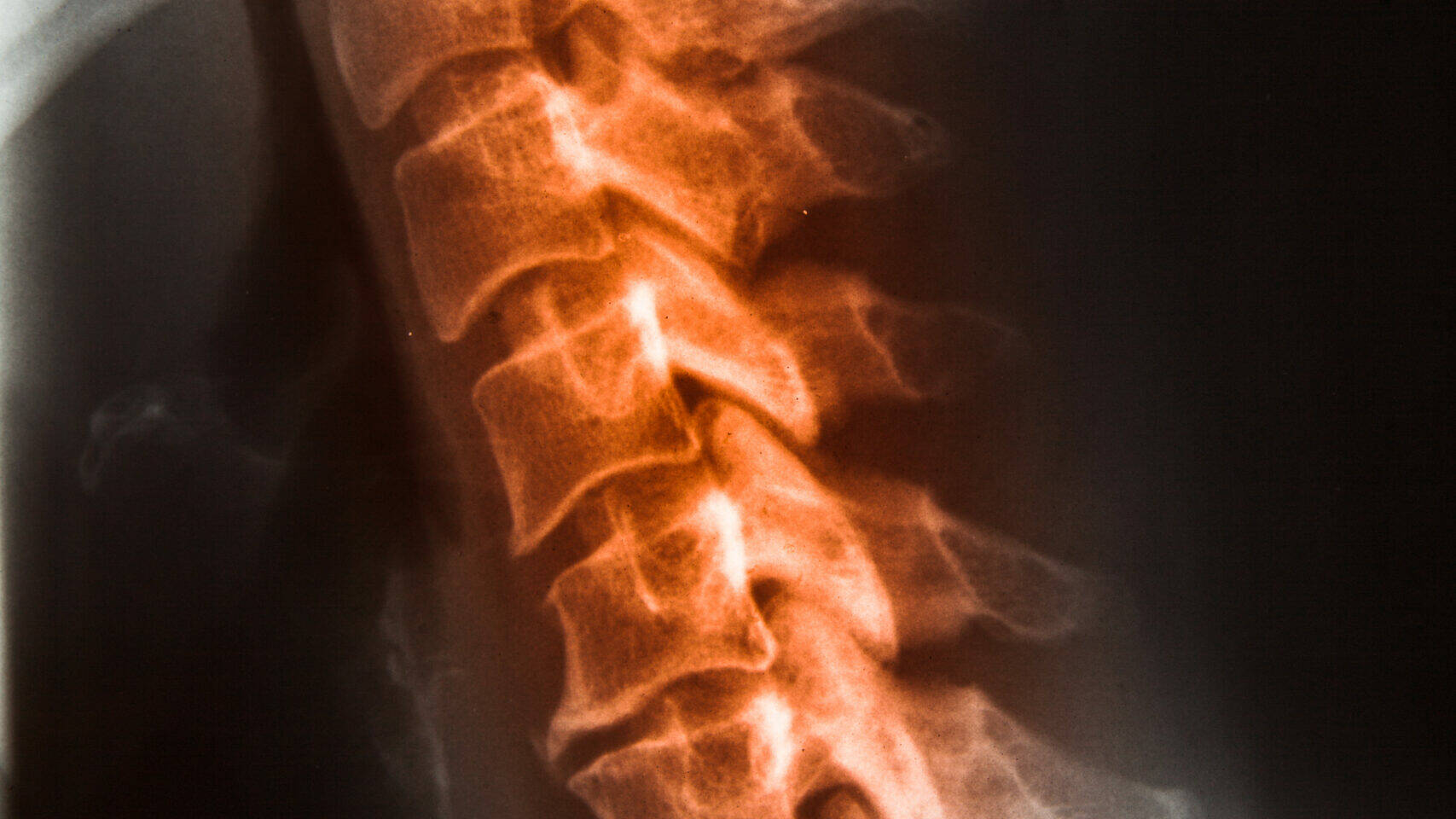 chiropractic x-rays in Denver, CO