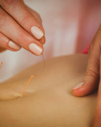Denver acupuncturist inserting acupuncture needles