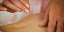 Denver acupuncturist inserting acupuncture needles