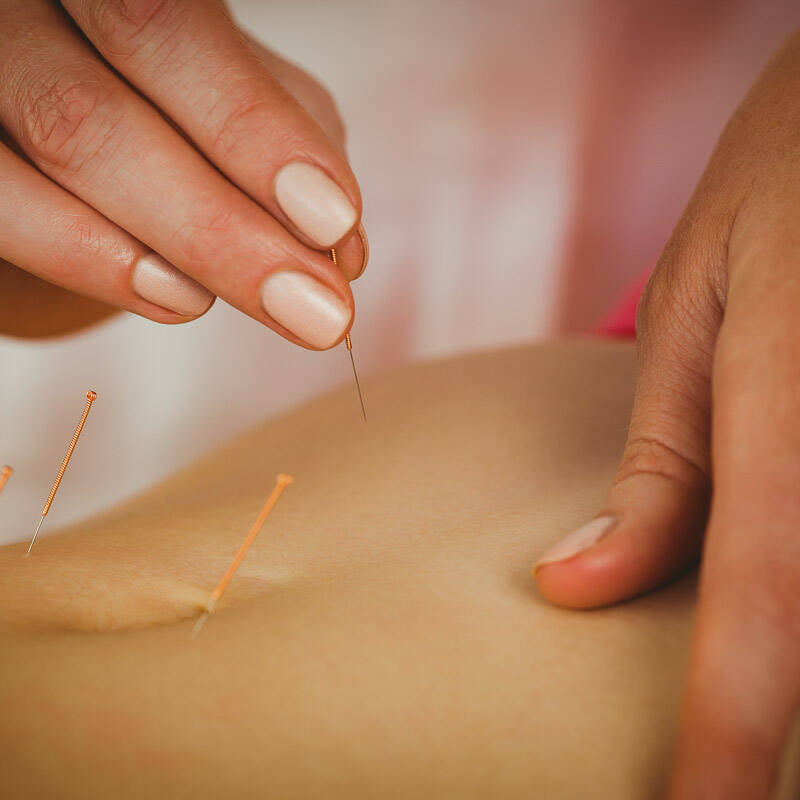 Expert dry needling in Denver