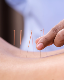 Denver acupuncture