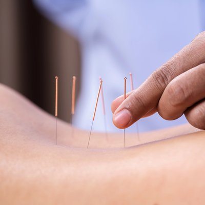 Patient in Denver receiving acupuncture