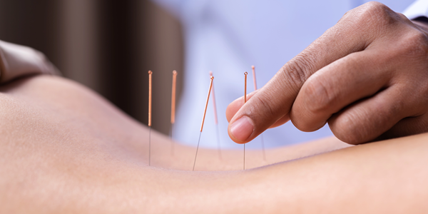 Patient in Denver receiving acupuncture