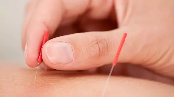 Dry Needling Chiropractor Maximizes Results