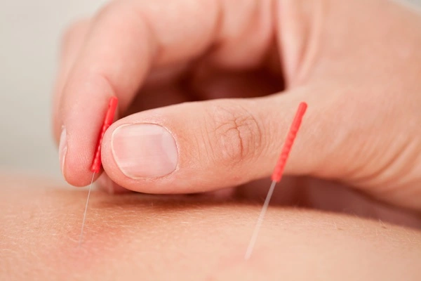 Dry Needling Chiropractor Maximizes Results