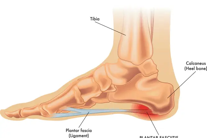 powerstep plantar fasciitis arch supports